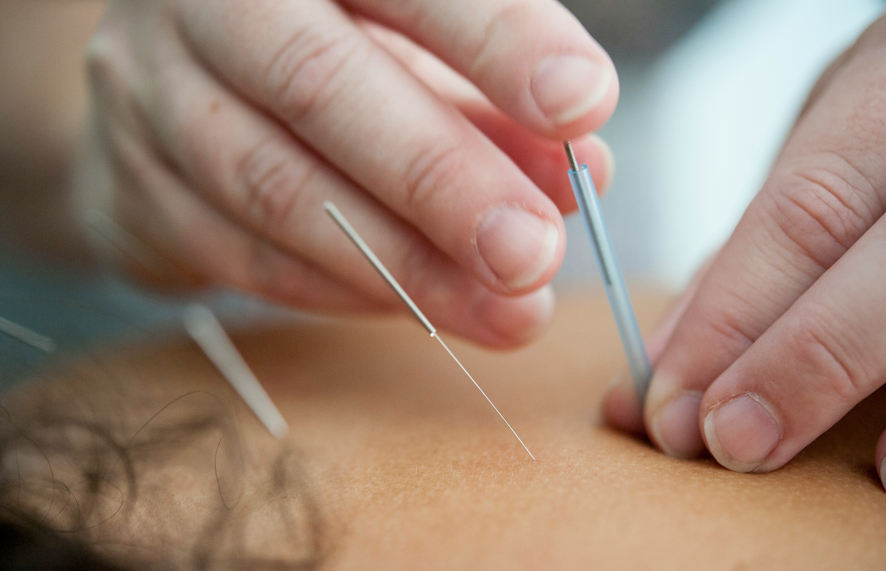 Tucson Acupuncture at Peaceful Spirit